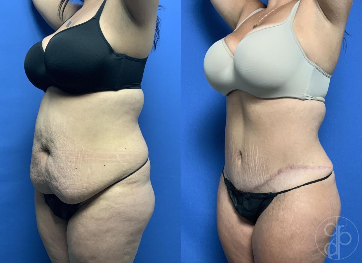 Before and after Abdominoplasty case 29578 - Angle 3