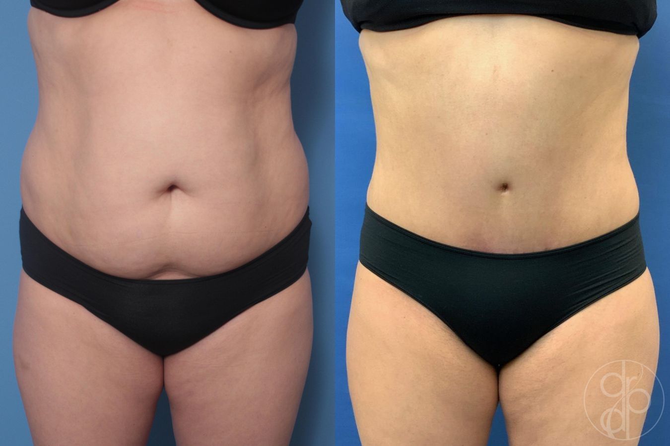 Before and after Liposuction case 29521
