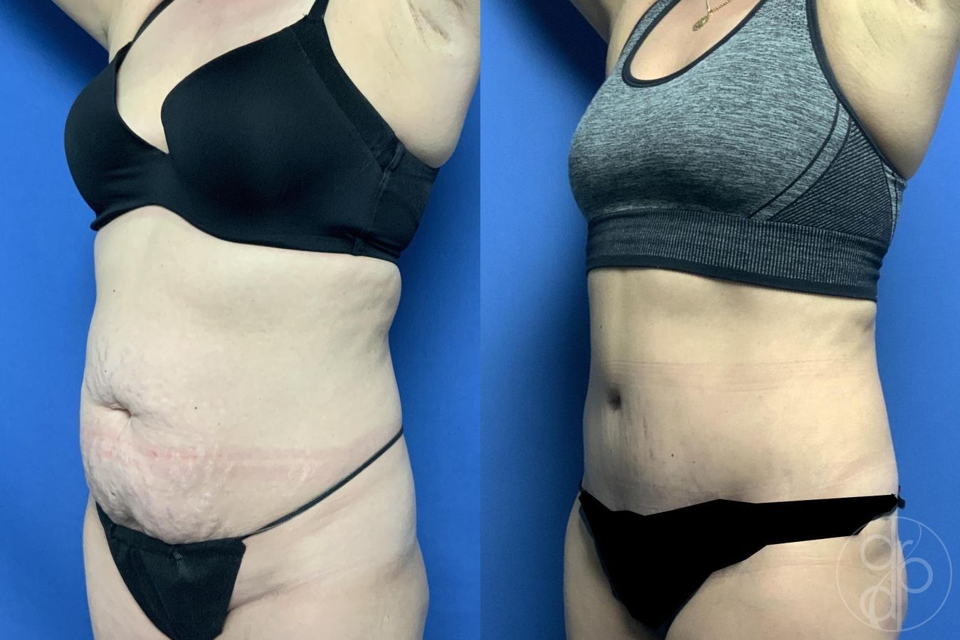 Before and after Abdominoplasty case 29563 - Angle 2