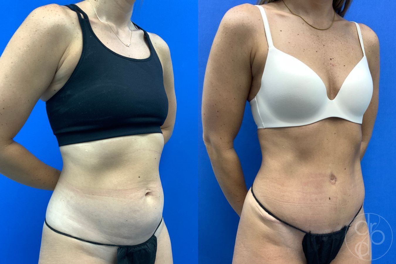 Before and after Abdominoplasty case 43175 - Angle 3