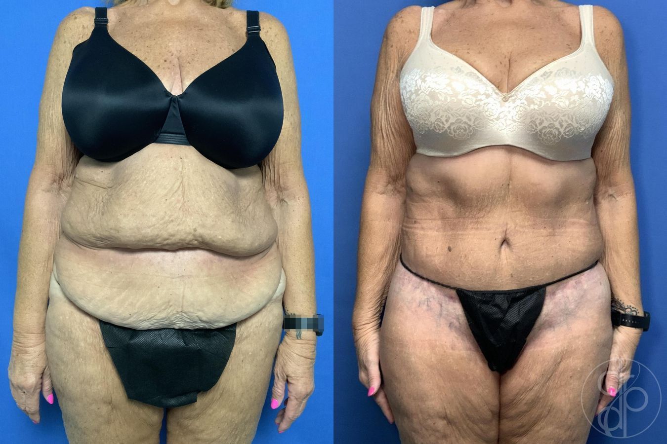 Before and after Abdominoplasty case 29620