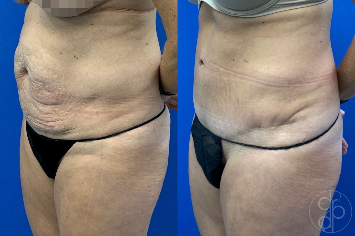 Before and after Abdominoplasty case 46417 - Angle 2