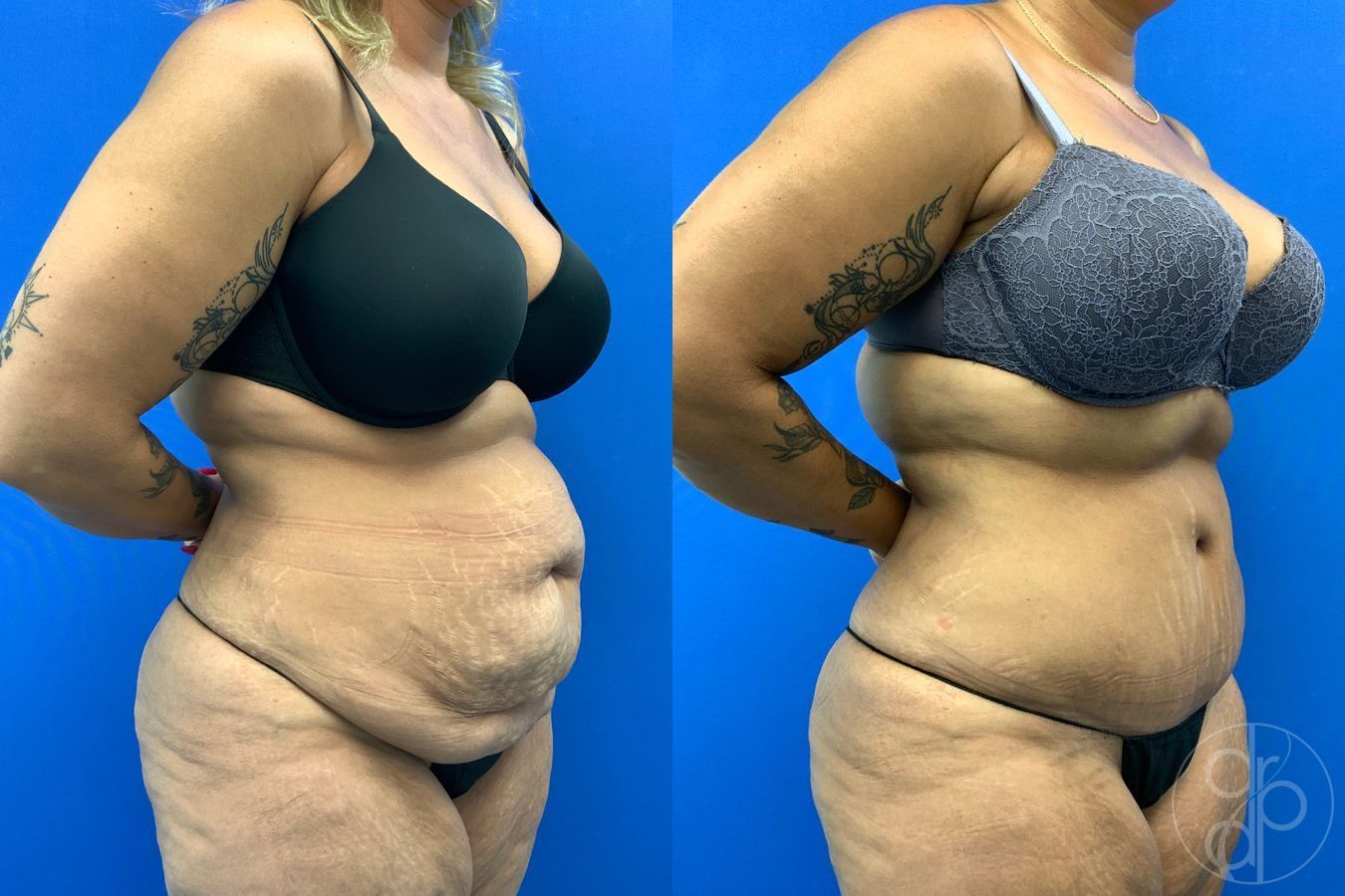 Before and after Abdominoplasty case 43473 - Angle 4
