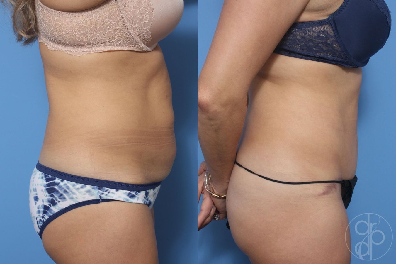 Before and after Abdominoplasty case 29523 - Angle 2