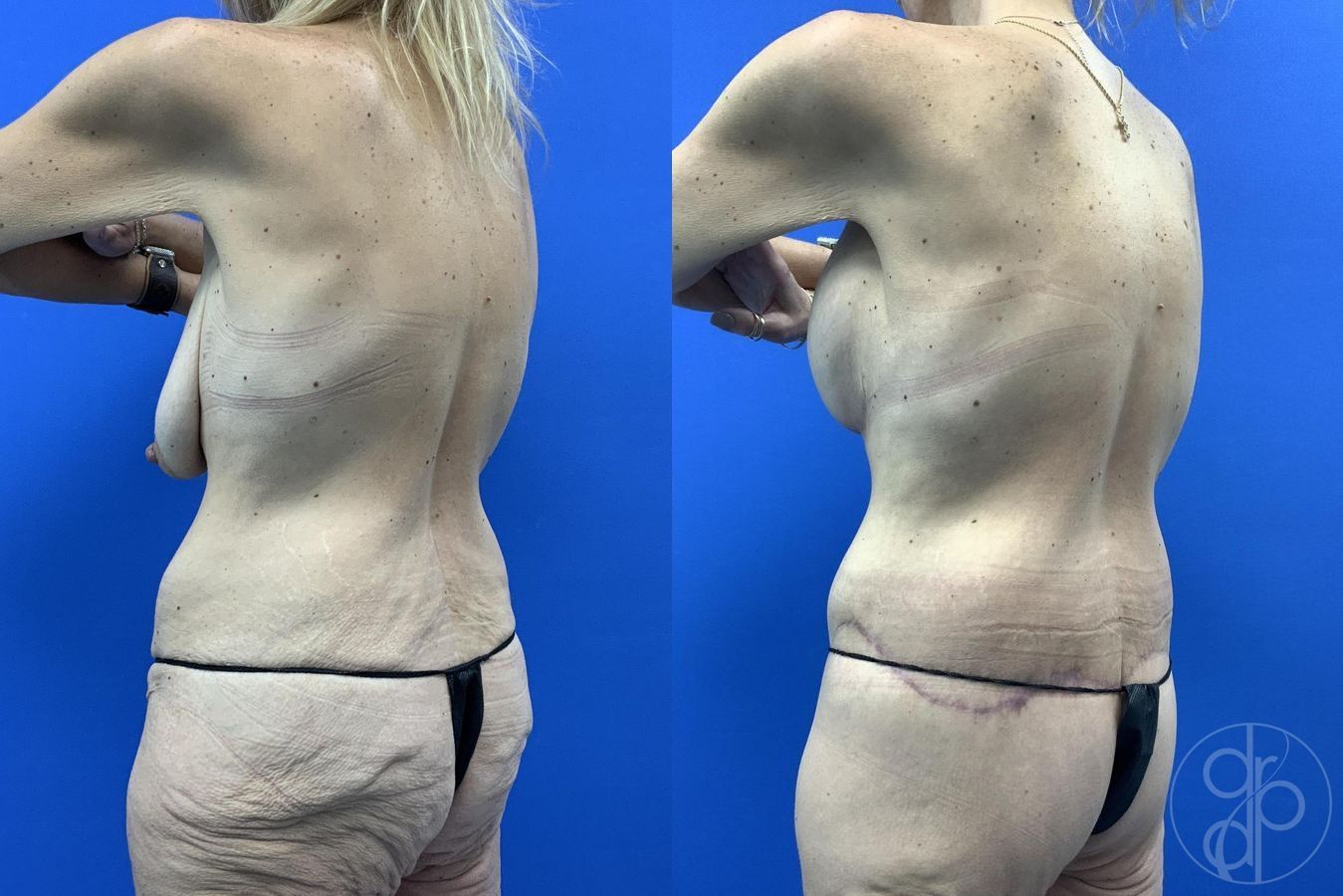 Before and after Abdominoplasty case 29983 - Angle 7
