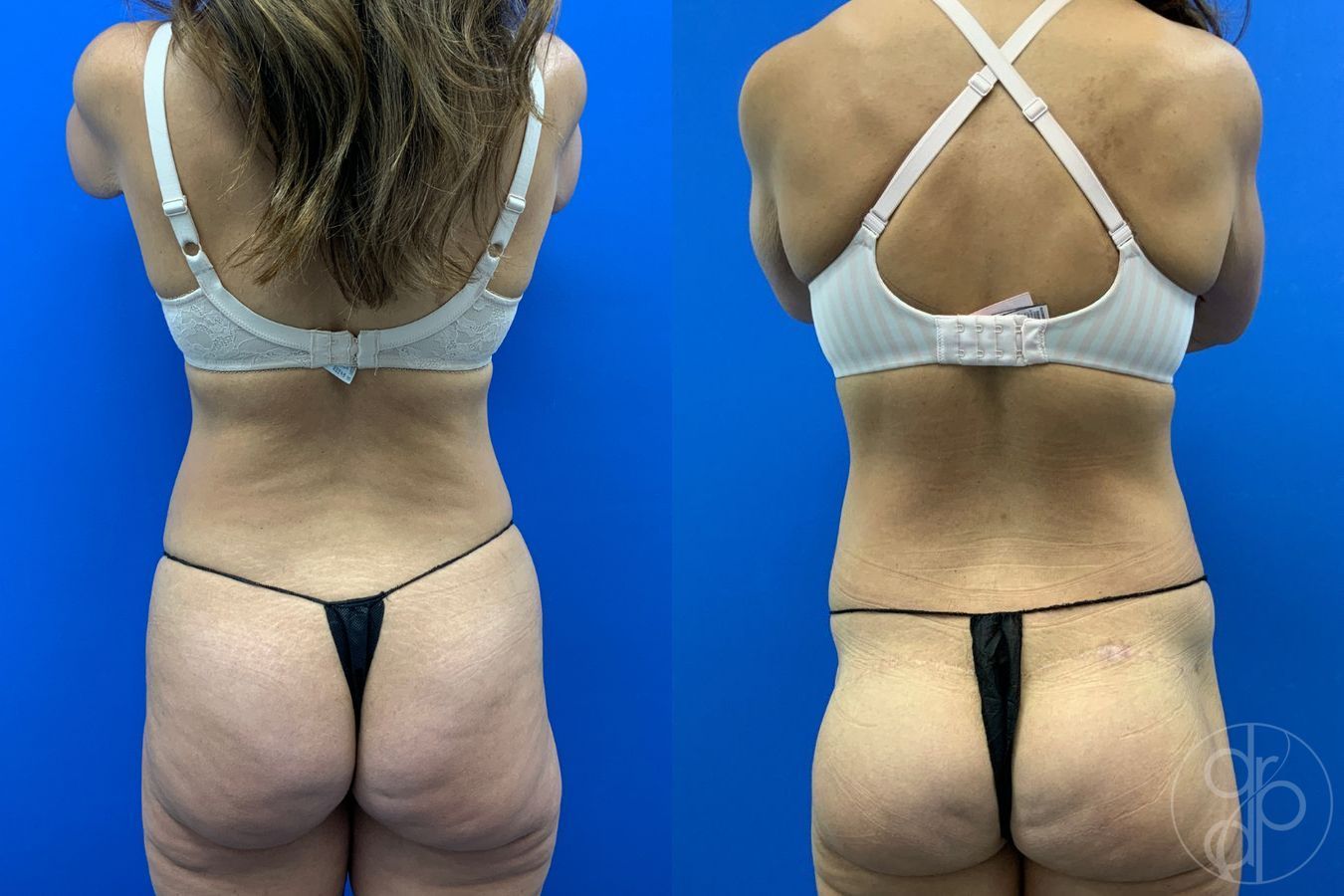 Before and after Abdominoplasty case 43480 - Angle 5