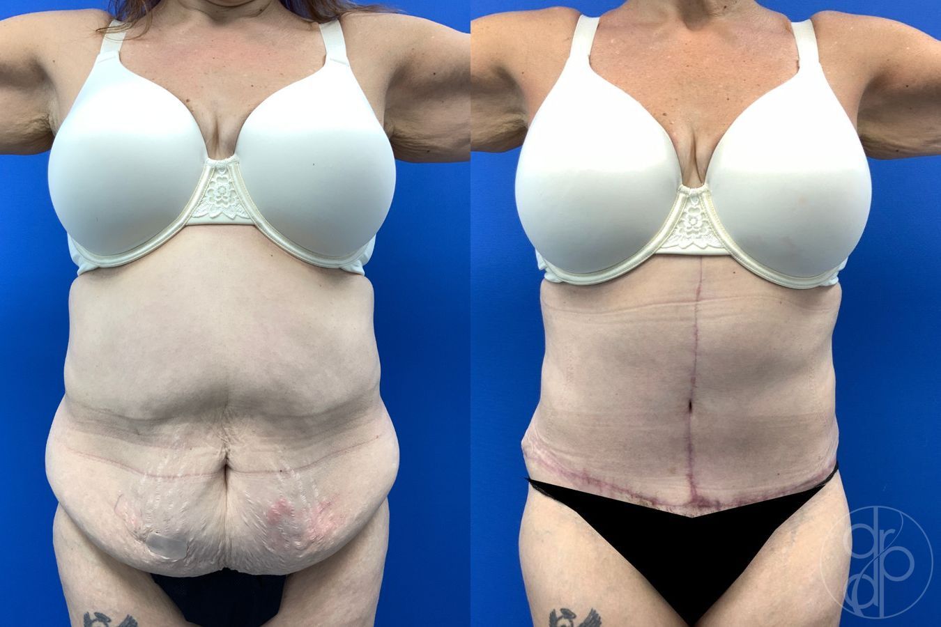 Before and after Abdominoplasty case 43458 - Angle 2