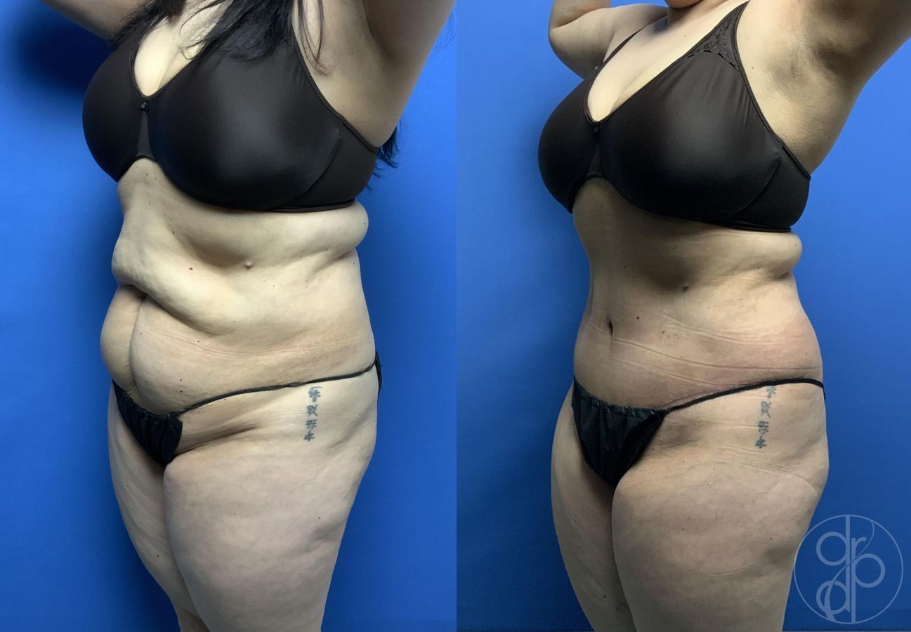 Before and after Abdominoplasty case 29569 - Angle 3