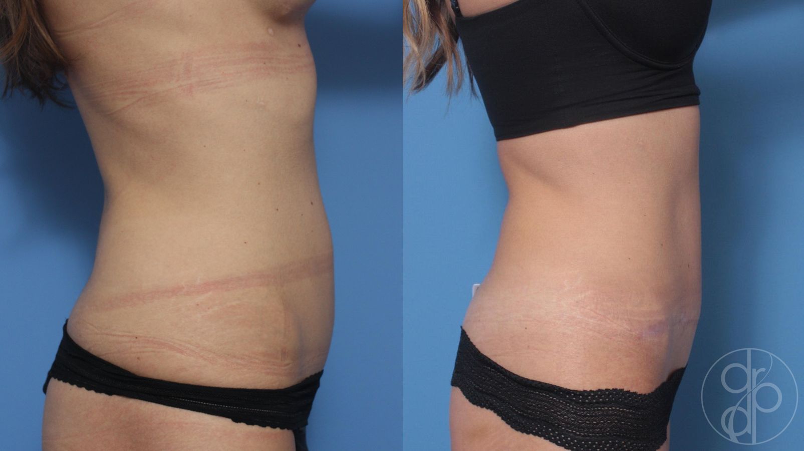 Before and after Abdominoplasty case 29522 - Angle 2