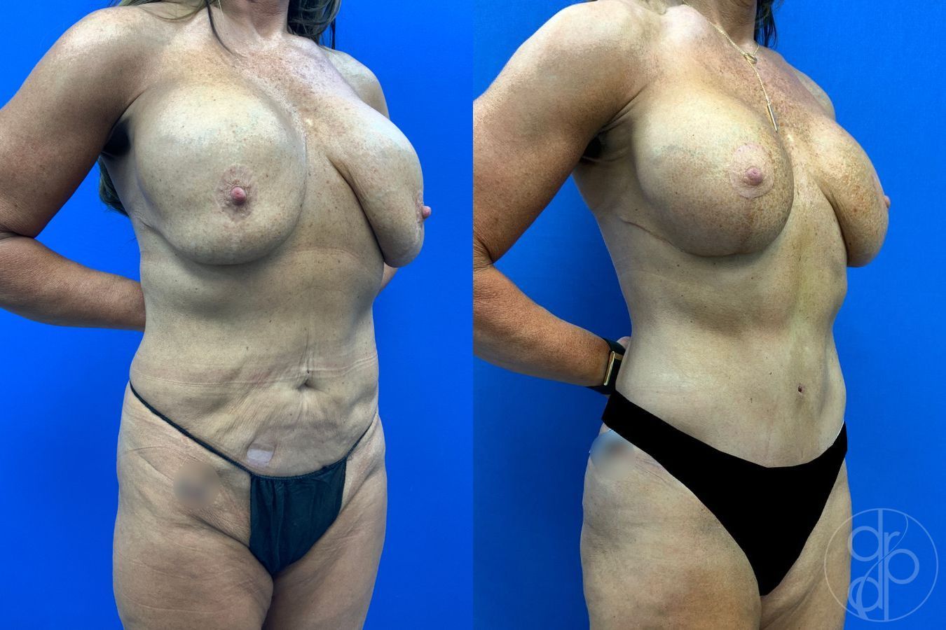 Before and after Mommy Makeover case 50316 - Angle 5