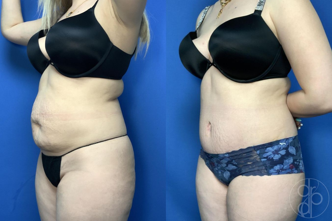Before and after Abdominoplasty case 30006 - Angle 3