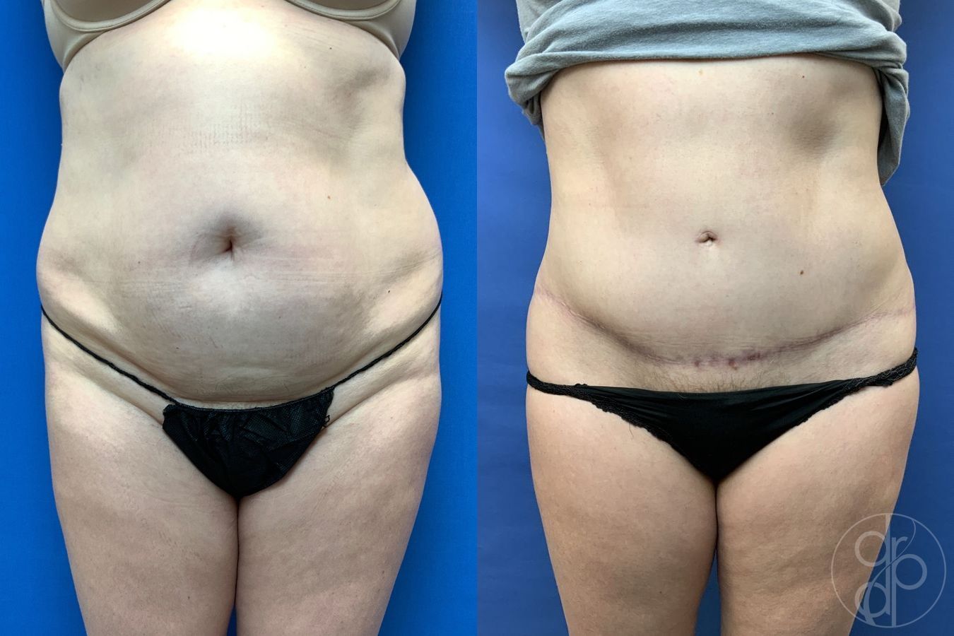 Before and after Abdominoplasty case 29579