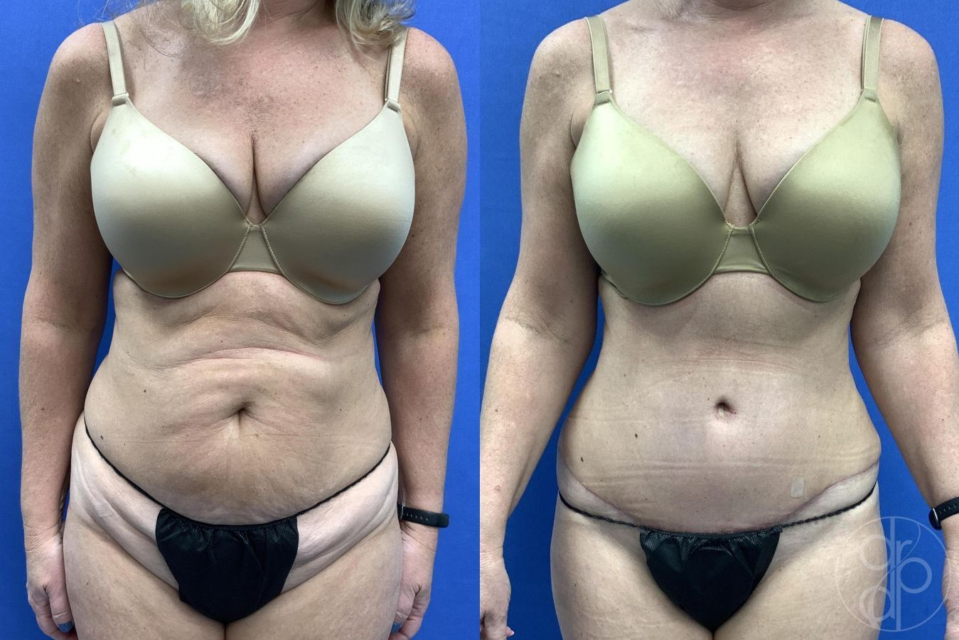 Before and after Abdominoplasty case 29654
