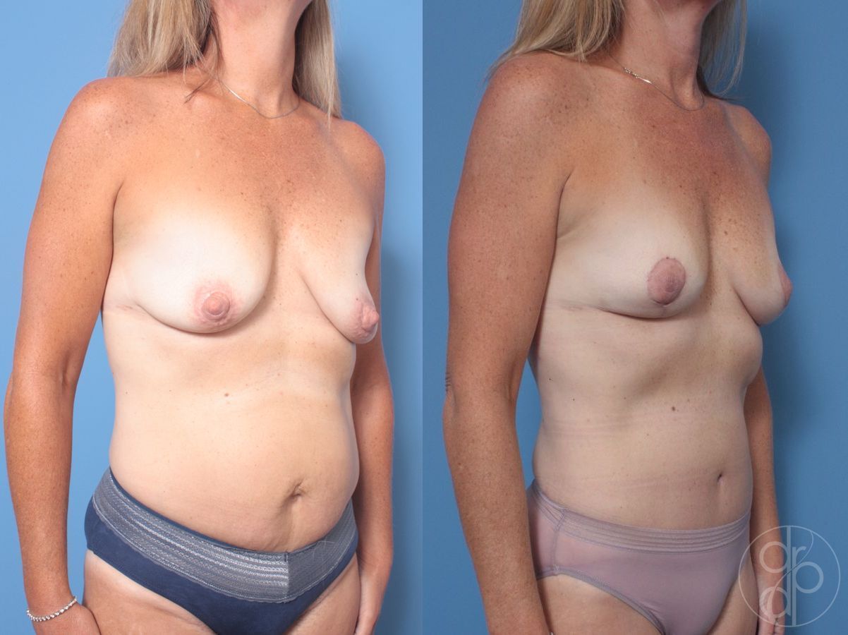 Before and after Abdominoplasty case 29665 - Angle 2