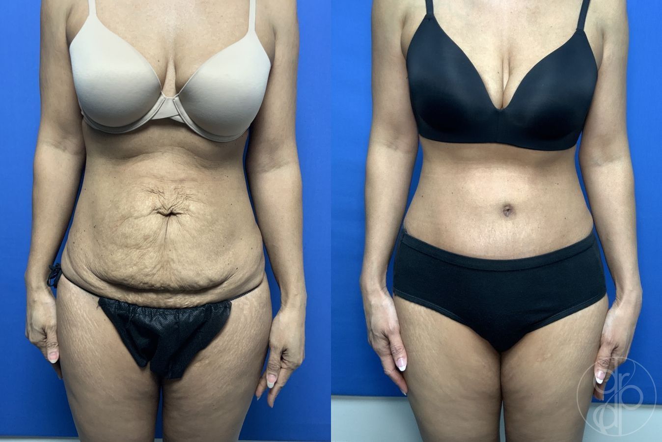 Before and after Abdominoplasty case 29540