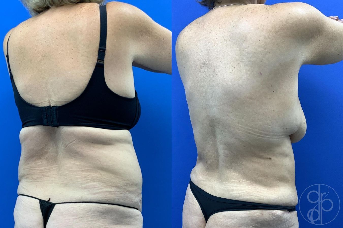 Abdominoplasty - Thumbnail 6