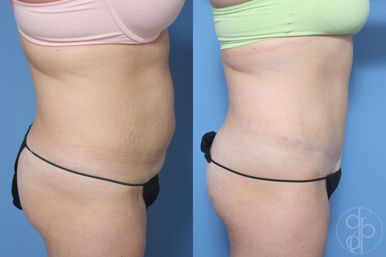 Before and after Abdominoplasty case 29533 - Angle 2