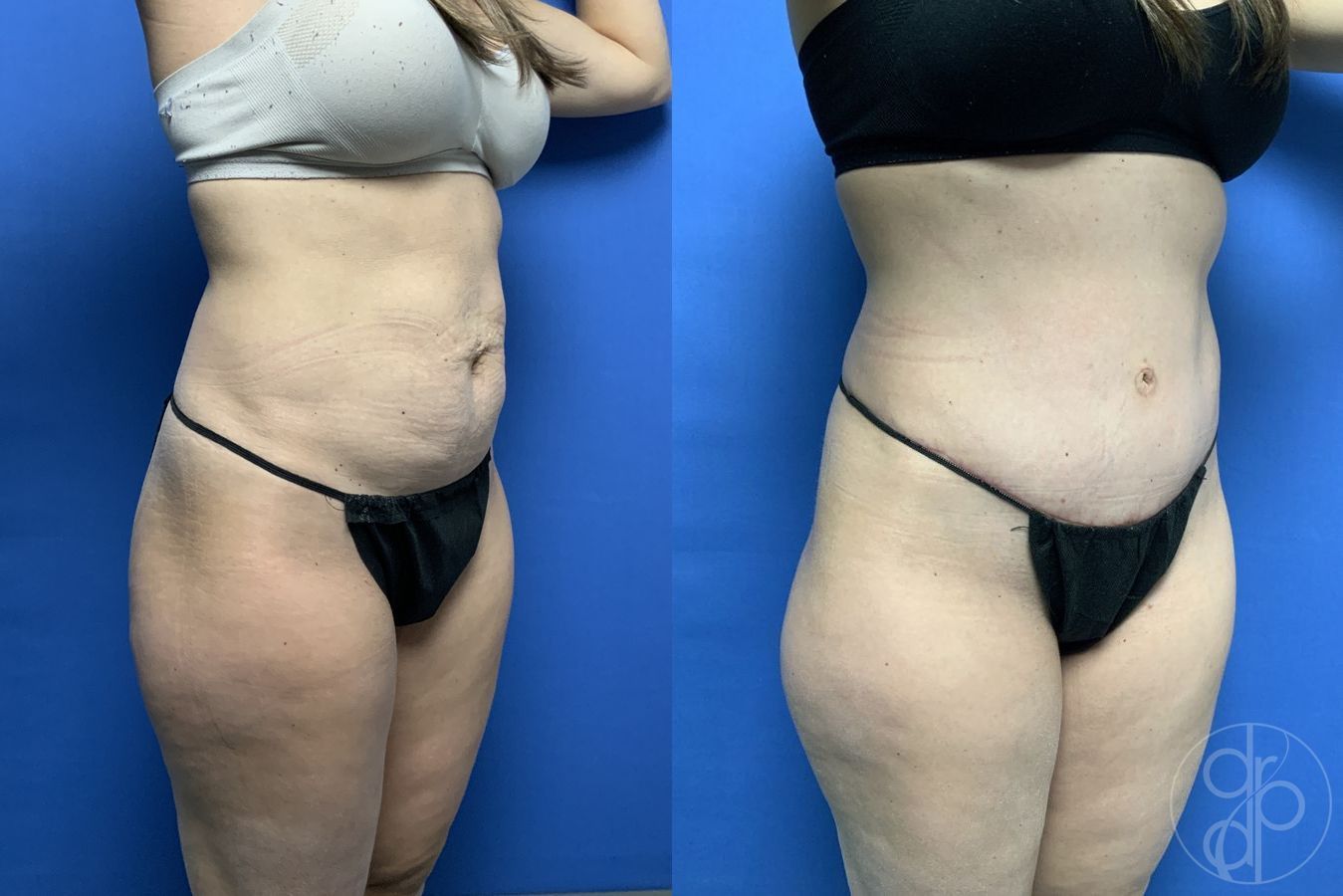 Before and after Abdominoplasty case 29580 - Angle 2