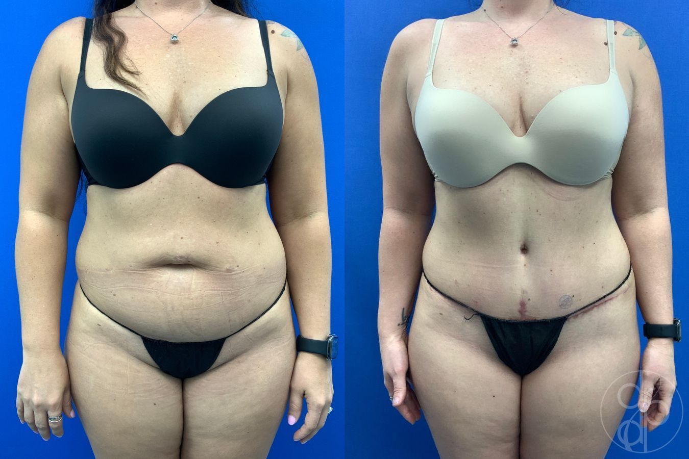 Before and after Abdominoplasty case 43461