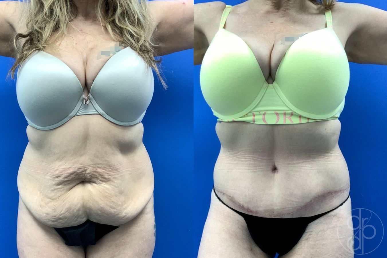 Before and after Abdominoplasty case 46426 - Angle 2