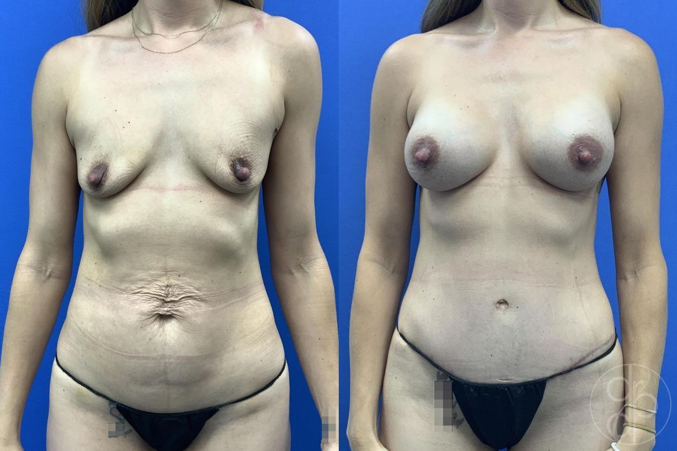 Before and after Abdominoplasty case 29642