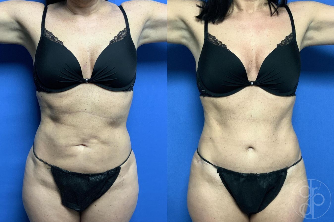 Before and after Abdominoplasty case 29613 - Angle 2