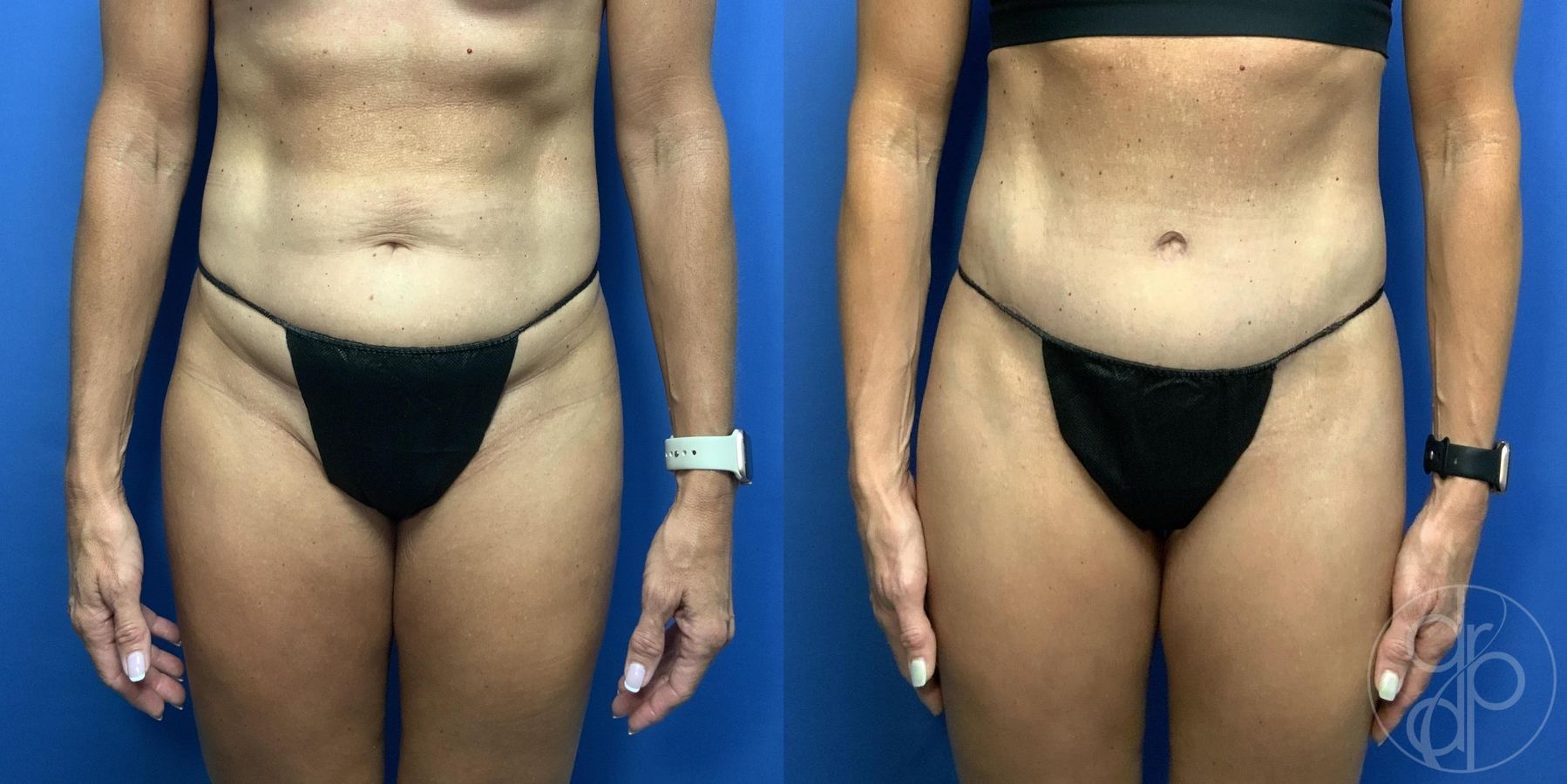 Before and after Abdominoplasty case 29994