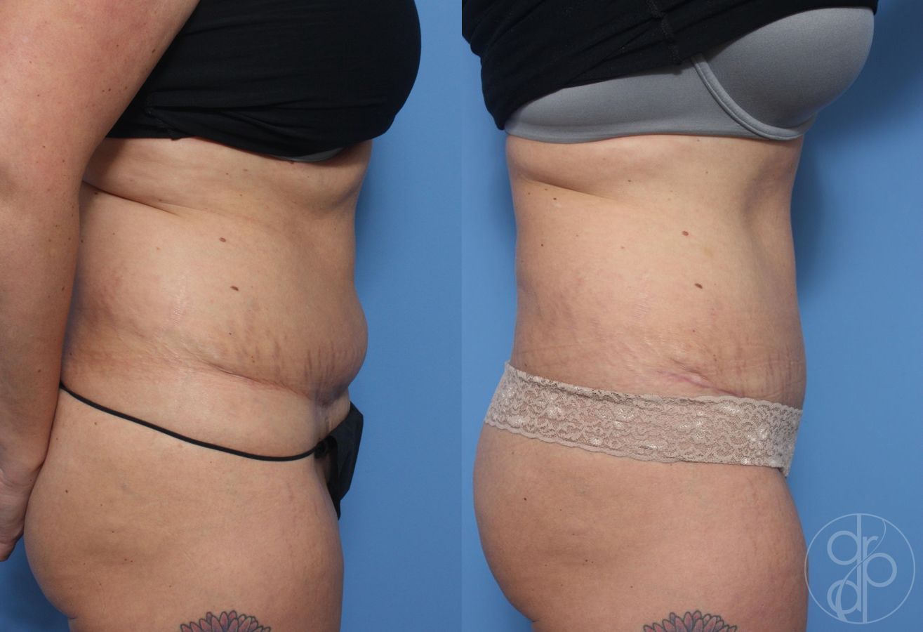 Before and after Abdominoplasty case 29550 - Angle 2