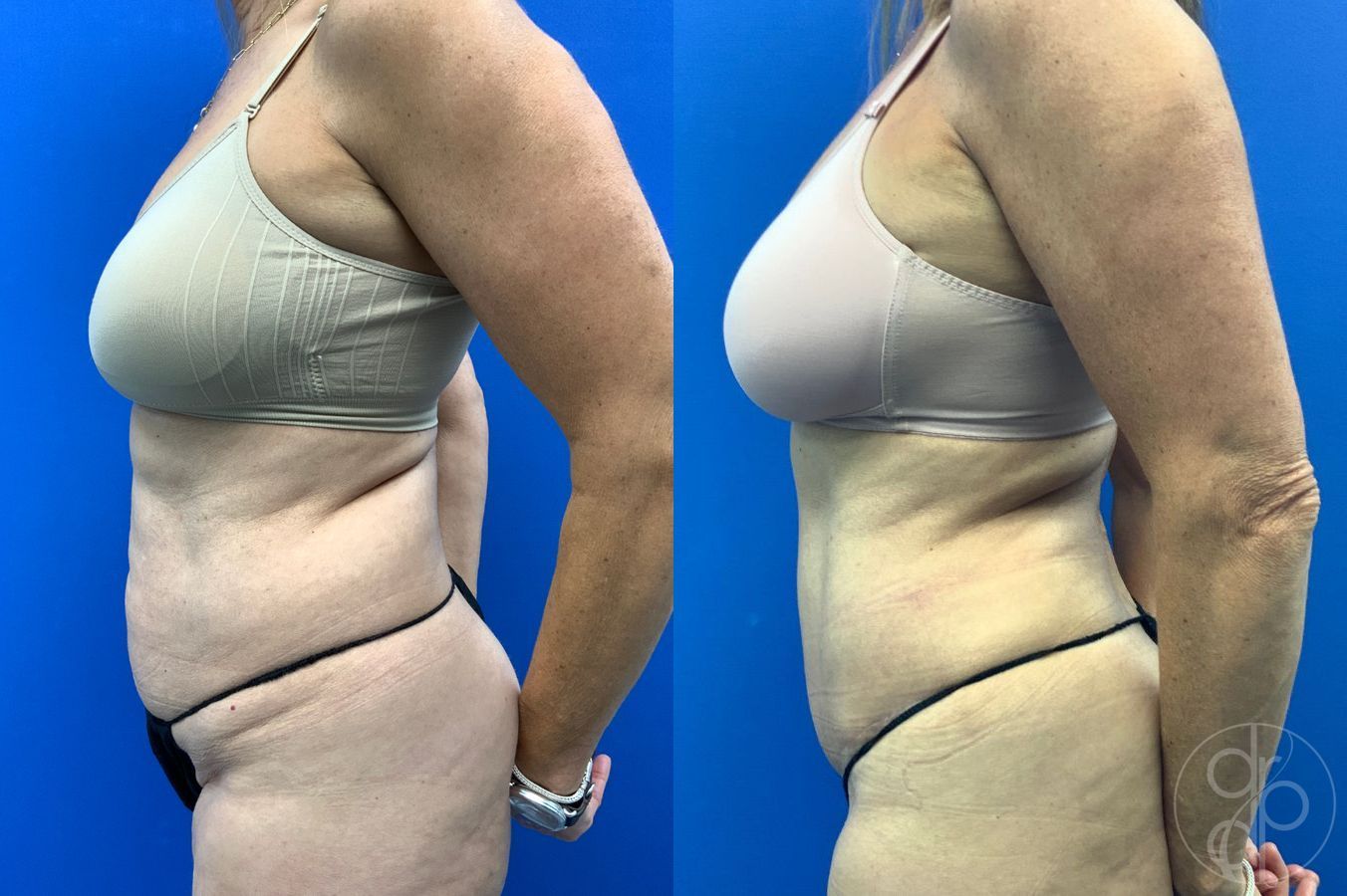 Before and after Abdominoplasty case 46404 - Angle 4