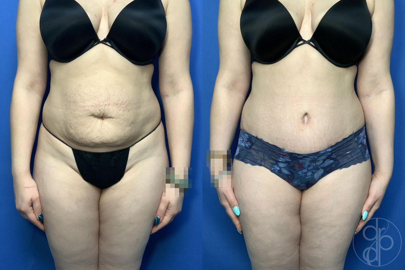 Before and after Abdominoplasty case 30006