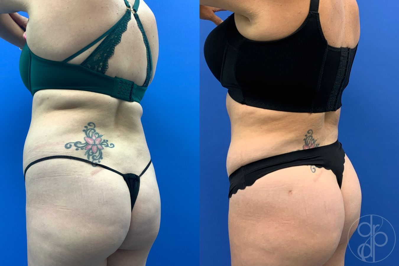 Before and after Liposuction case 43486 - Angle 6