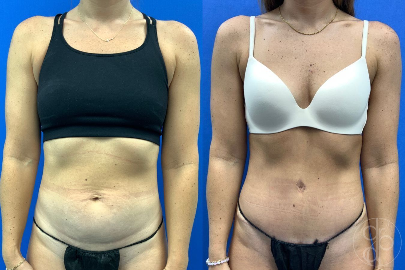Before and after Abdominoplasty case 43175
