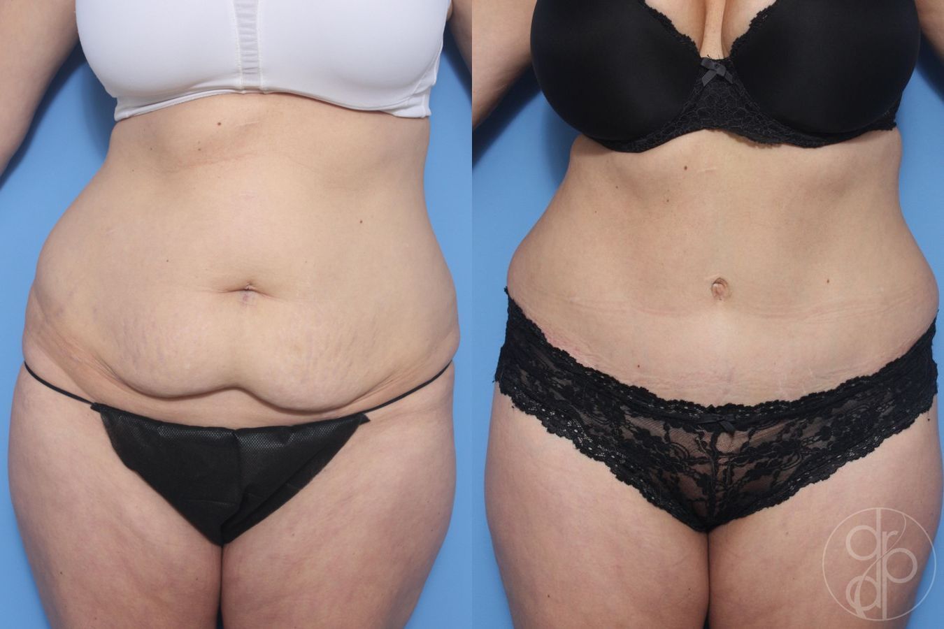 Before and after Abdominoplasty case 29536