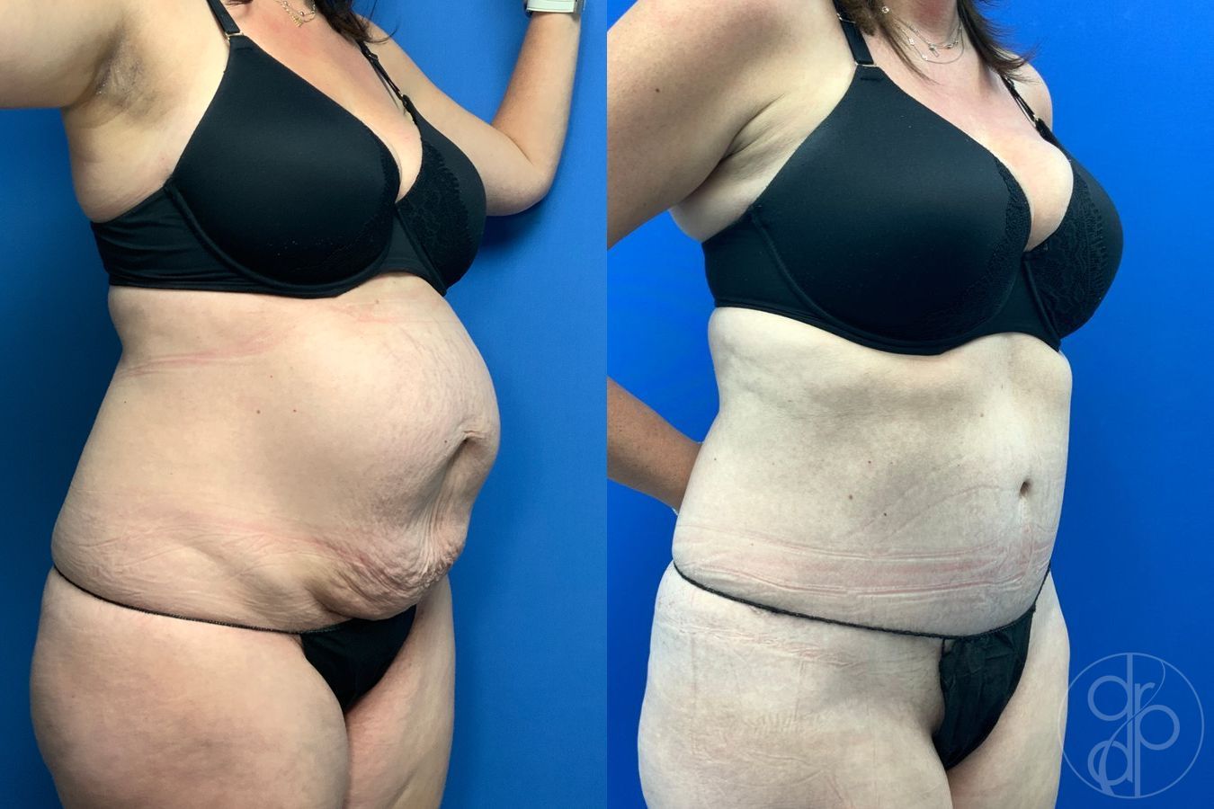 Before and after Abdominoplasty case 43192 - Angle 4