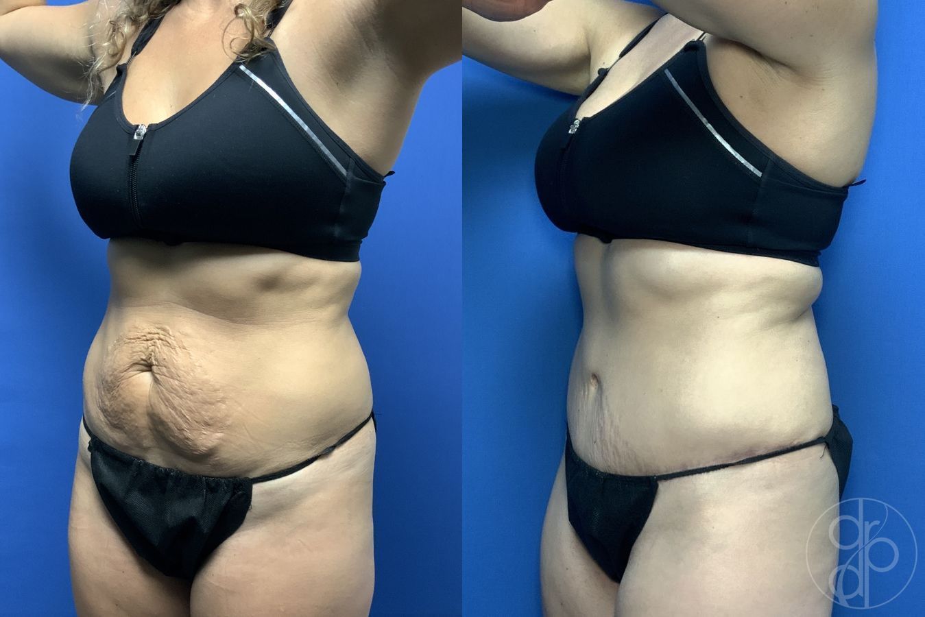 Before and after Abdominoplasty case 29574 - Angle 2