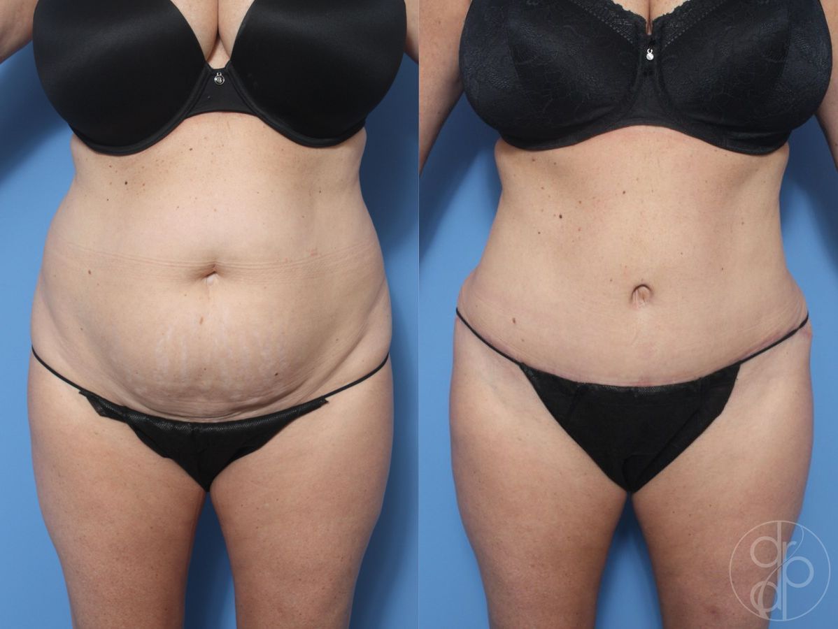 Before and after Abdominoplasty case 29527