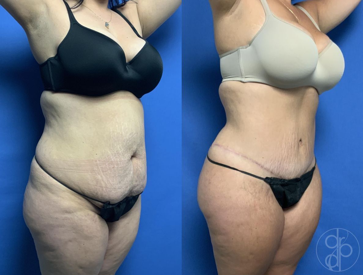 Before and after Abdominoplasty case 29578 - Angle 2