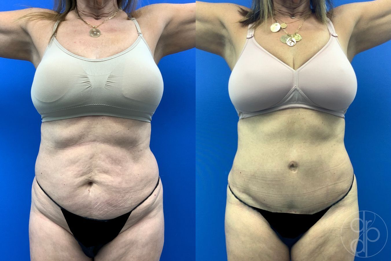 Before and after Abdominoplasty case 46404 - Angle 2