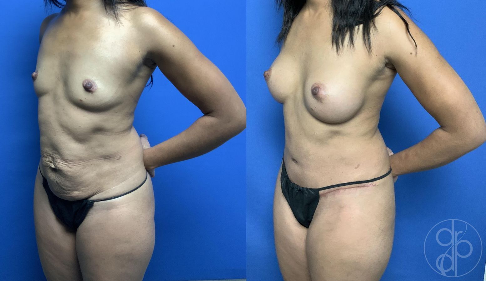 Before and after Abdominoplasty case 29685 - Angle 3