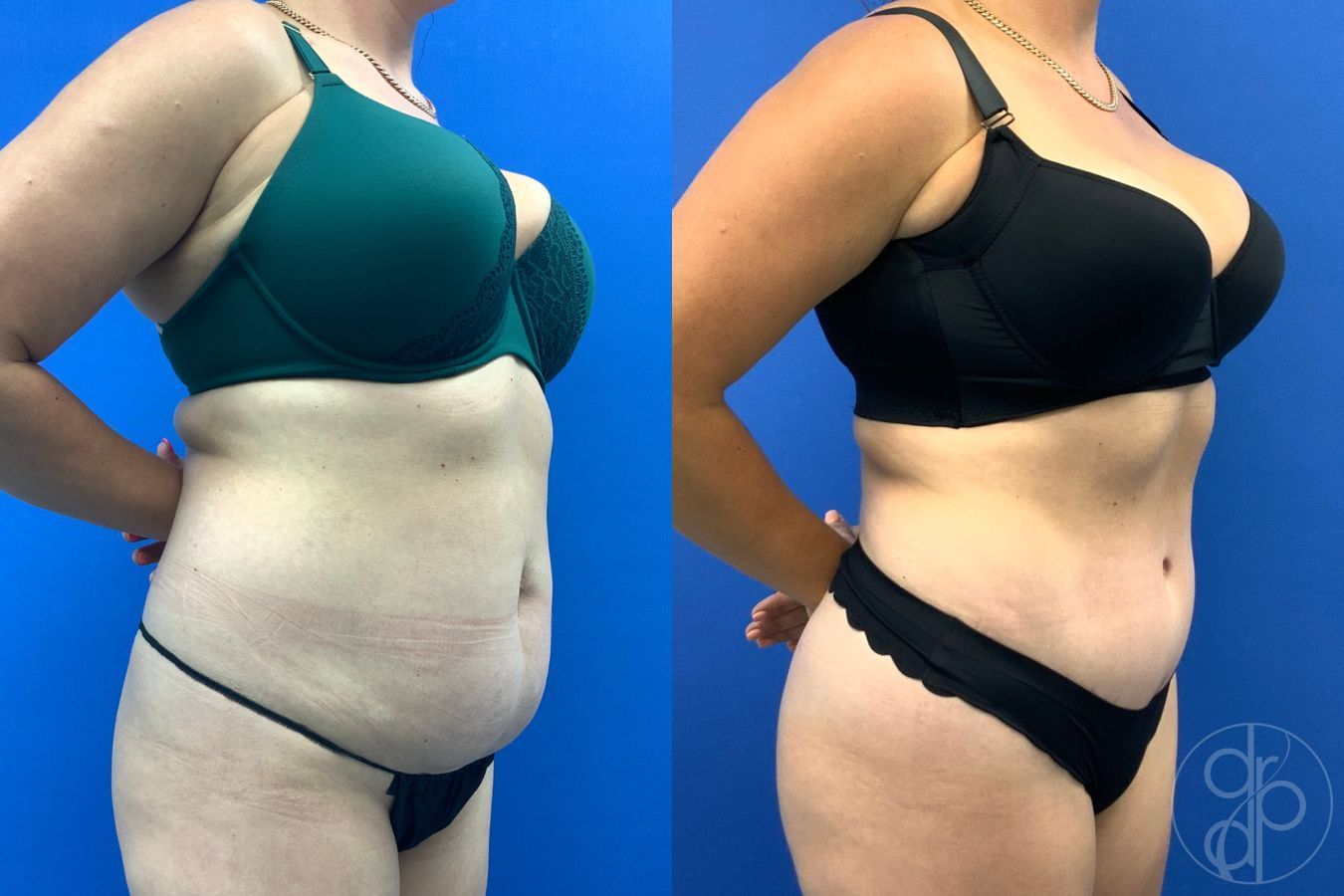Before and after Liposuction case 43486 - Angle 2