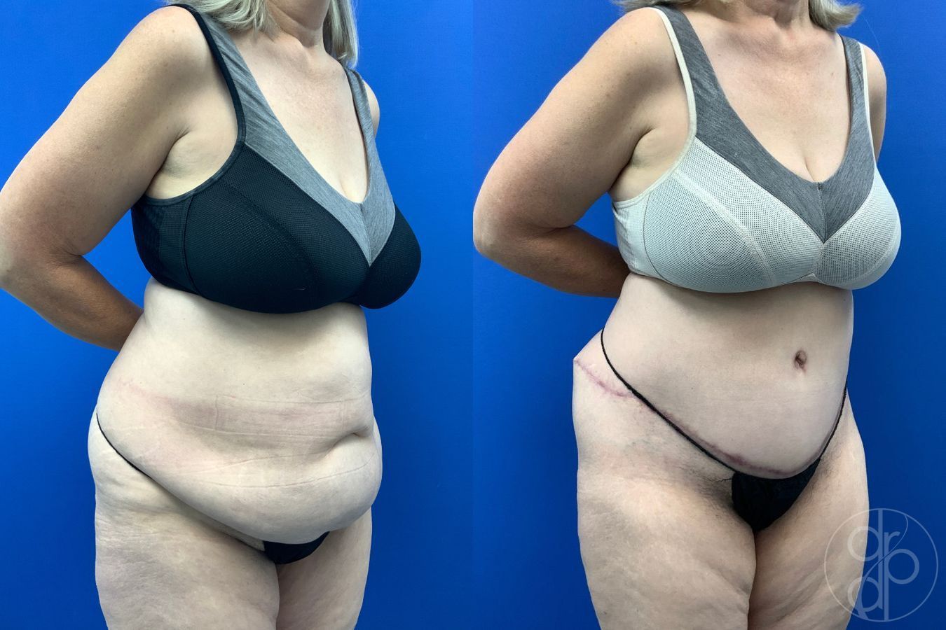 Before and after Abdominoplasty case 43487 - Angle 4