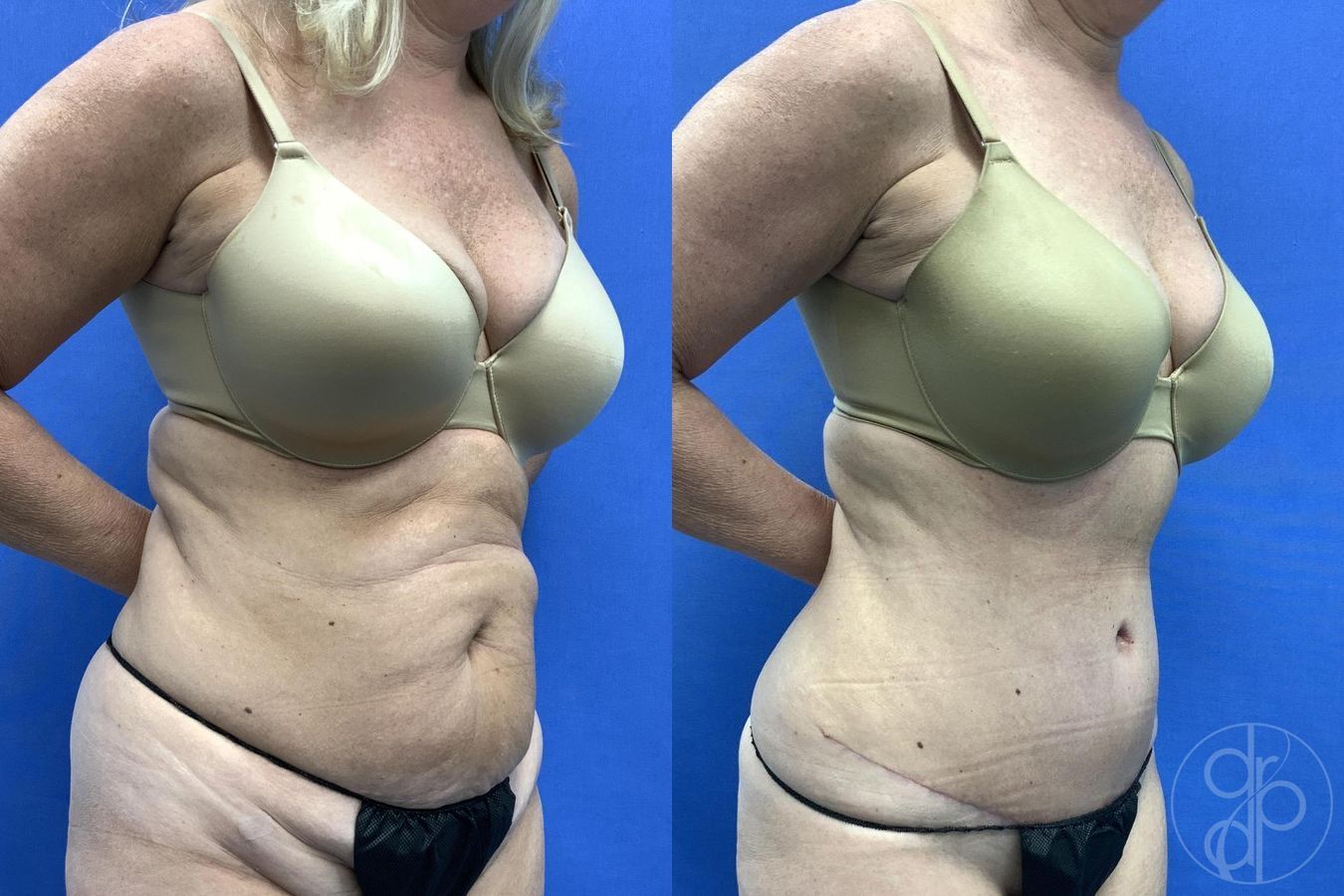 Before and after Abdominoplasty case 29654 - Angle 4