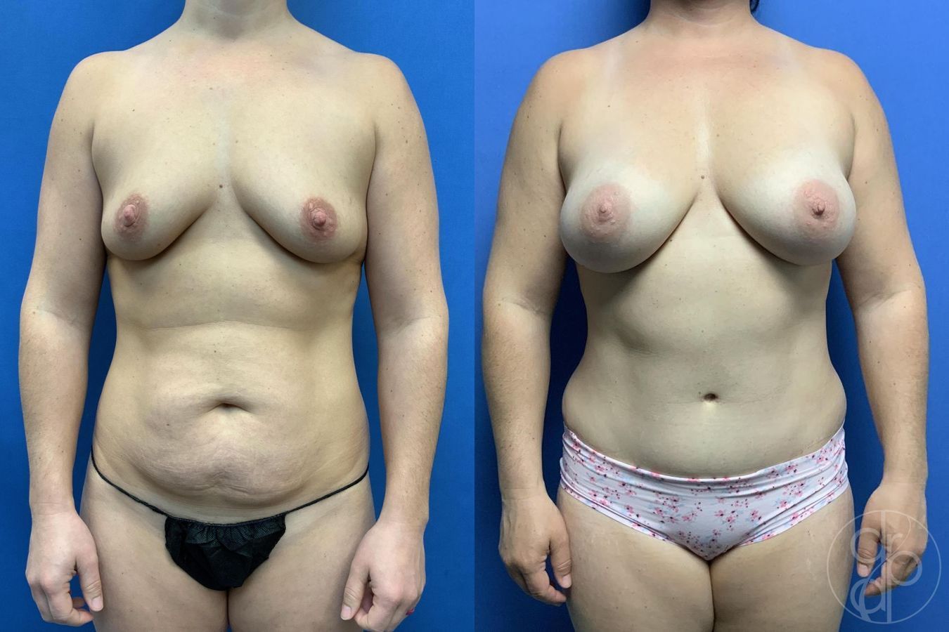 Before and after Abdominoplasty case 29698
