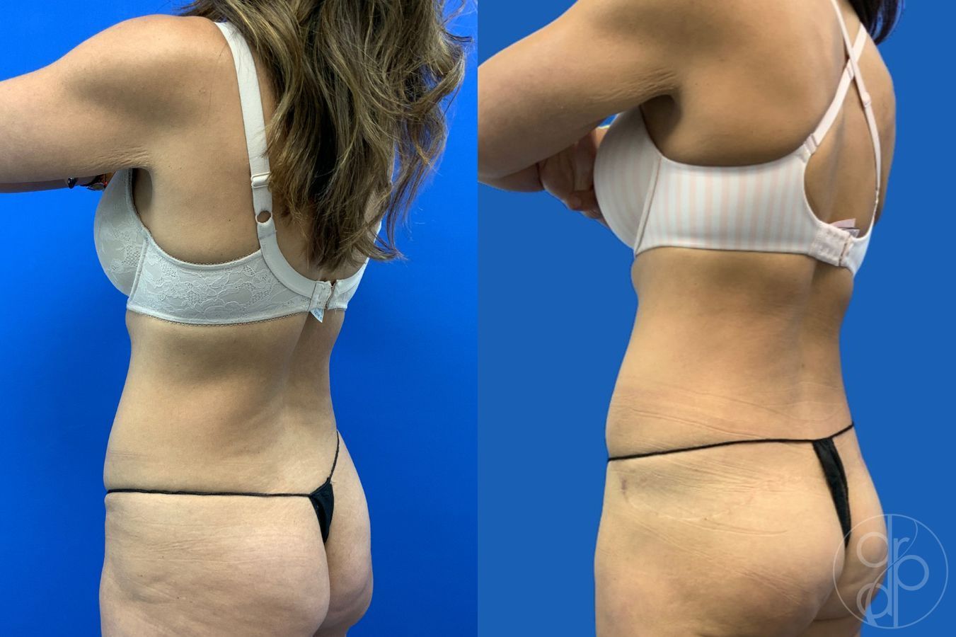 Before and after Abdominoplasty case 43480 - Angle 4