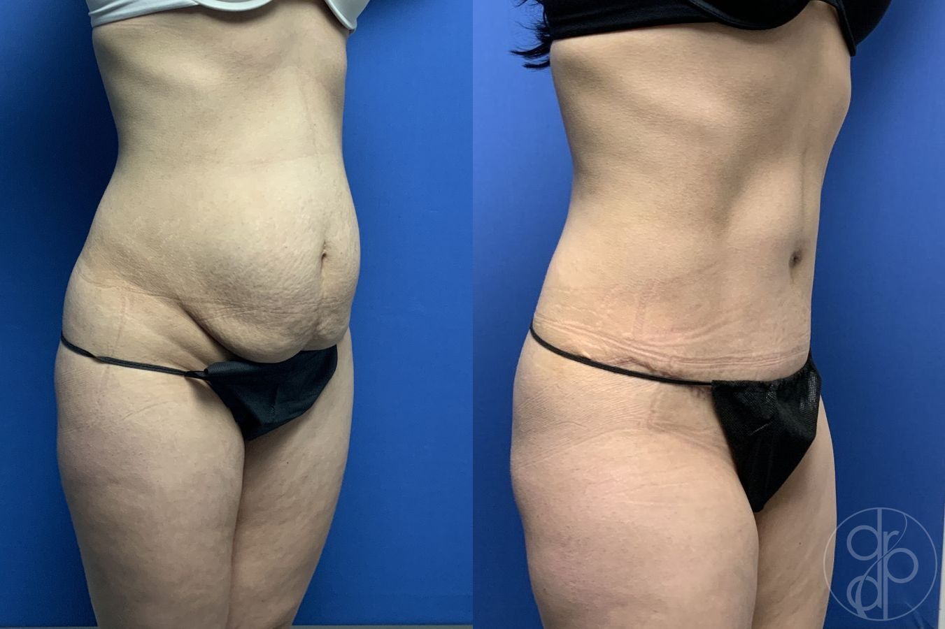 Before and after Abdominoplasty case 29565 - Angle 3