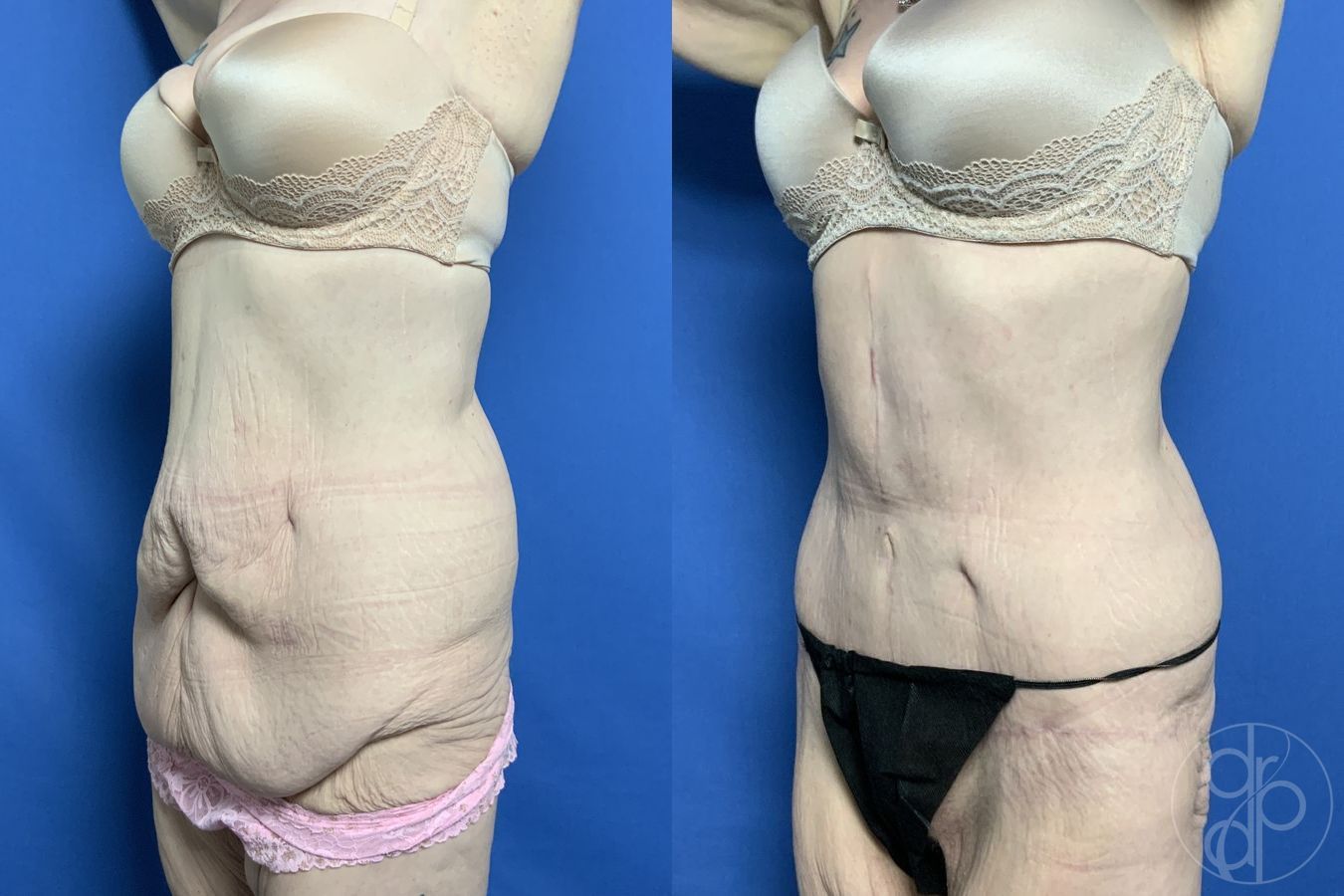 Abdominoplasty - Thumbnail 3