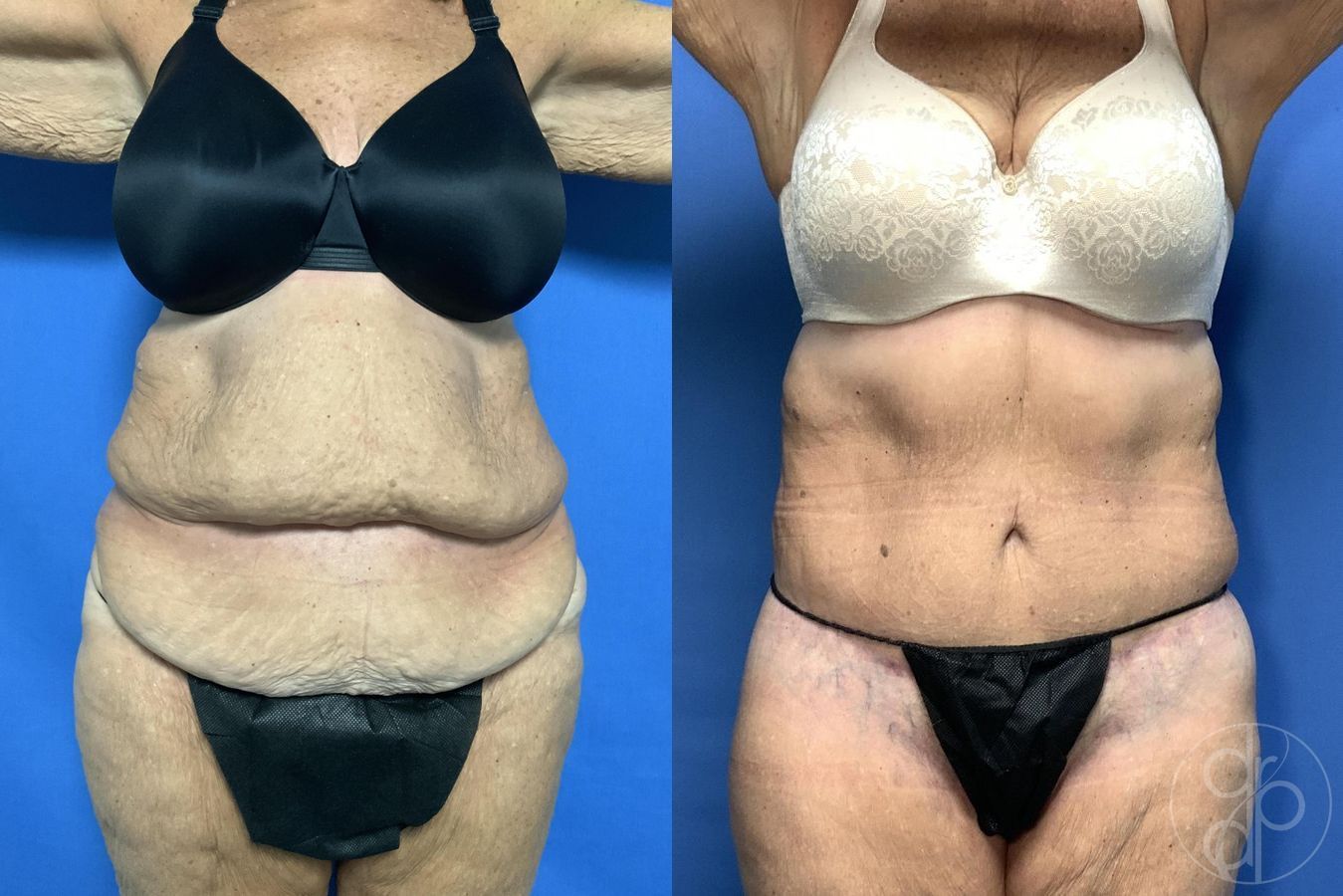 Before and after Abdominoplasty case 29620 - Angle 2
