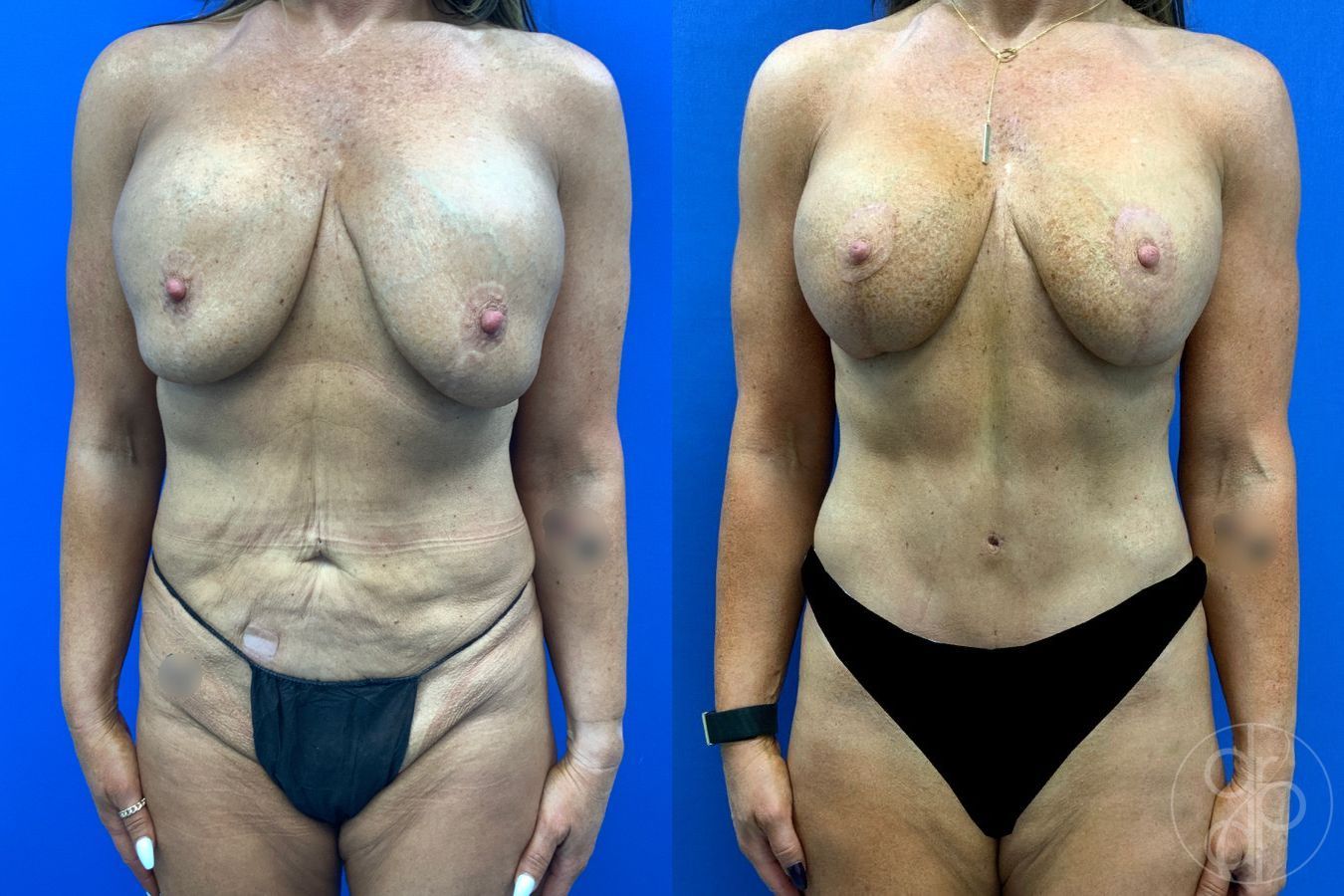 Before and after Mommy Makeover case 50316