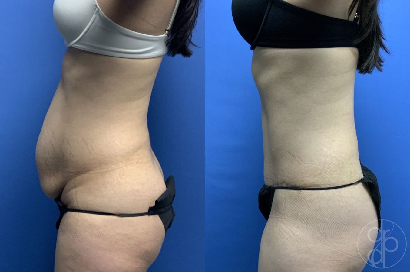 Before and after Abdominoplasty case 29565 - Angle 2
