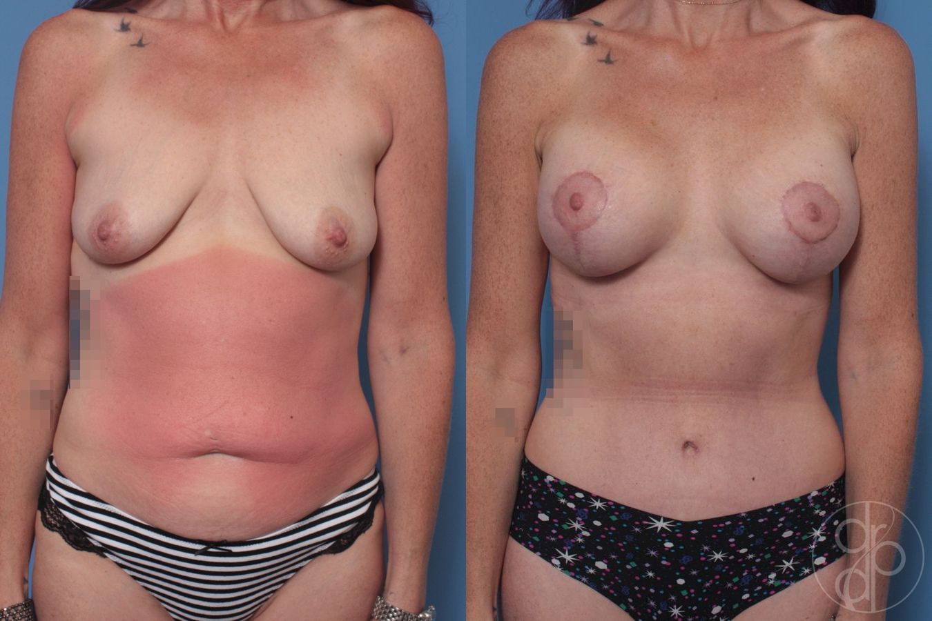 Before and after Abdominoplasty case 29688